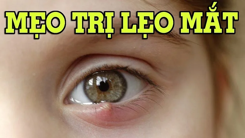 Mẹo chữa lẹo mắt tại nhà an toàn, dễ thực hiện