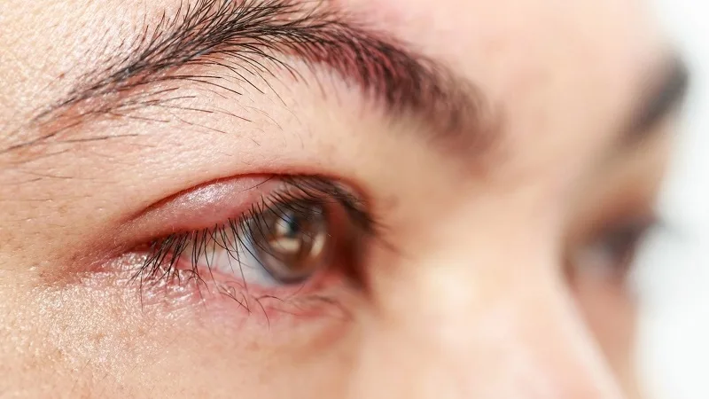 Những cách chữa lẹo mắt cần tránh